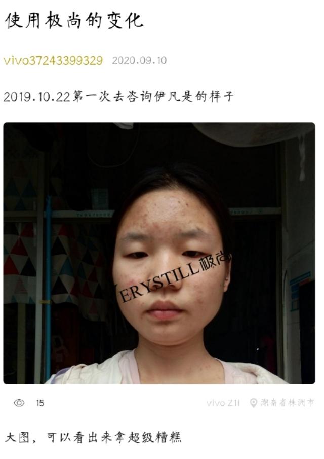 本人八年战痘血泪史，你有耐心看完嘛？