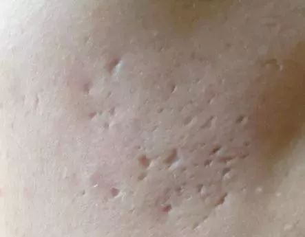 痘印心得经验_痘印的解决方法_痘印的烦恼