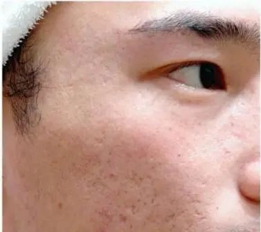 痘印心得经验_痘印的解决方法_痘印的烦恼