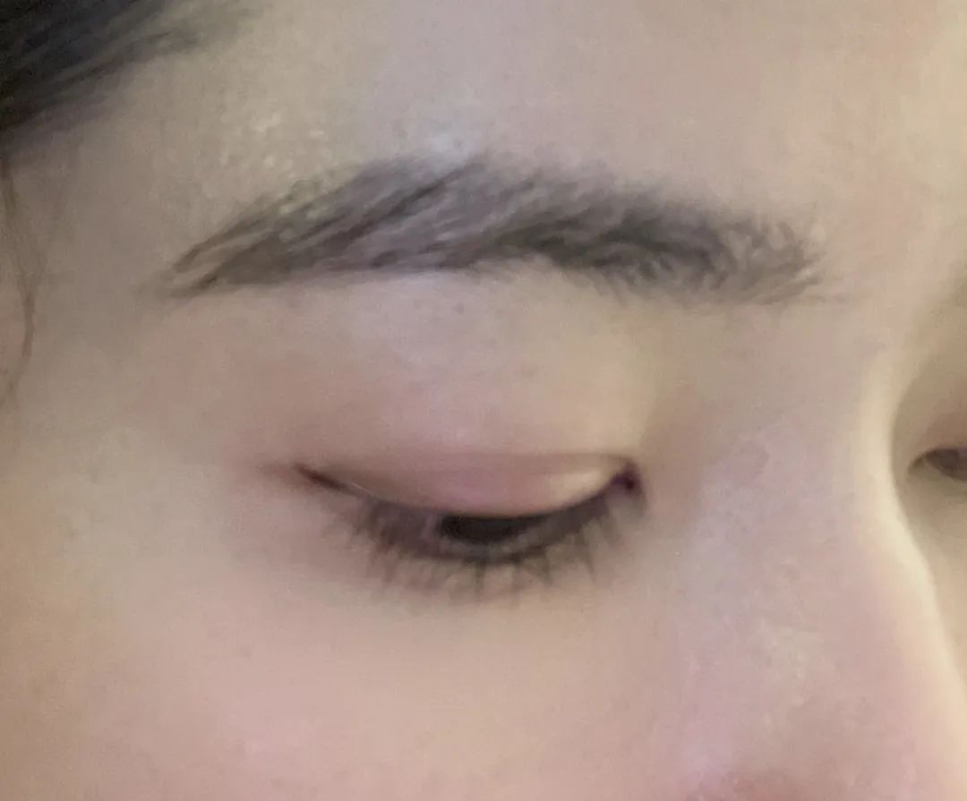 痘印如何处理_痘印过程_痘印心得经验