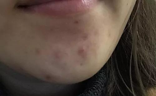 痘印的烦恼_痘印日常_痘印心得经验