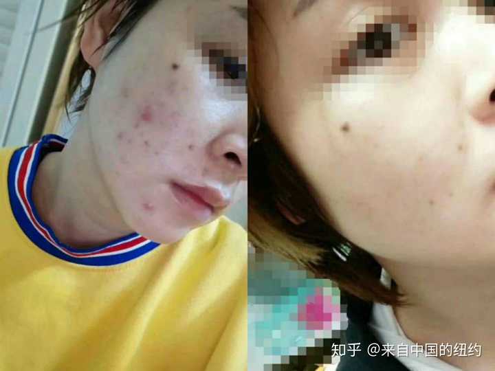 有什么祛痘的好方法？